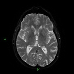 Cerebral amyloid angiopathy (Radiopaedia 77506-89664 Axial DWI 43).jpg