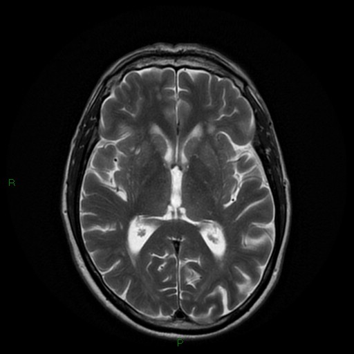 File:Cerebral amyloid angiopathy (Radiopaedia 77506-89664 Axial T2 15).jpg