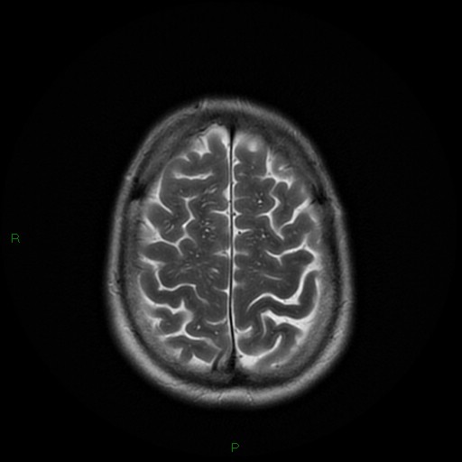 File:Cerebral amyloid angiopathy (Radiopaedia 77506-89664 Axial T2 24).jpg