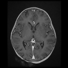 Cerebral and spinal tuberculosis (Radiopaedia 90489-107837 Axial T1 C+ 103).jpg