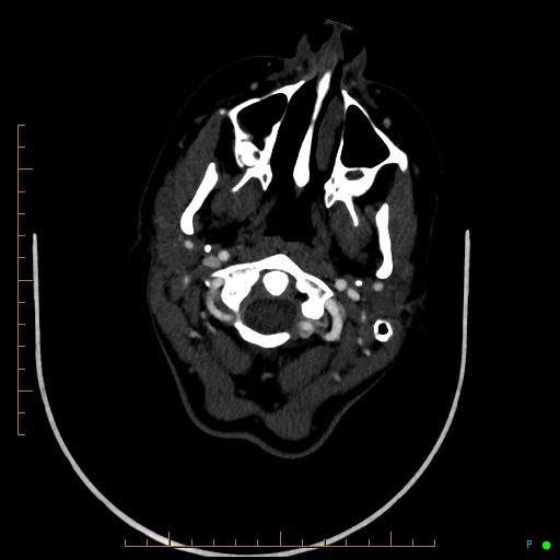 Cerebral arteriovenous malformation (AVM) (Radiopaedia 78162-90706 Axial CTA 34).jpg
