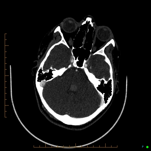 Cerebral arteriovenous malformation (AVM) (Radiopaedia 78162-90706 Axial CTA 91).jpg