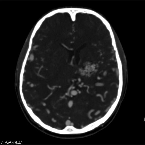 File:Cerebral arteriovenous malformation (Radiopaedia 28518-28759 B 27).jpg