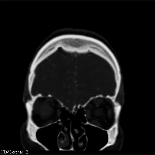 File:Cerebral arteriovenous malformation (Radiopaedia 28518-28759 C 12).jpg