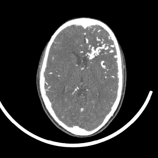 Cerebral arteriovenous malformation (Radiopaedia 29531-30031 E 10).jpg
