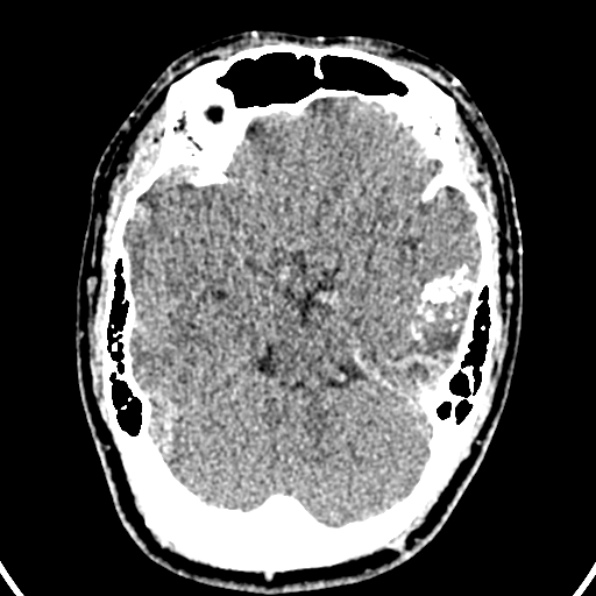 Cerebral arteriovenous malformation (Radiopaedia 37182-39012 Axial non-contrast 17).jpg