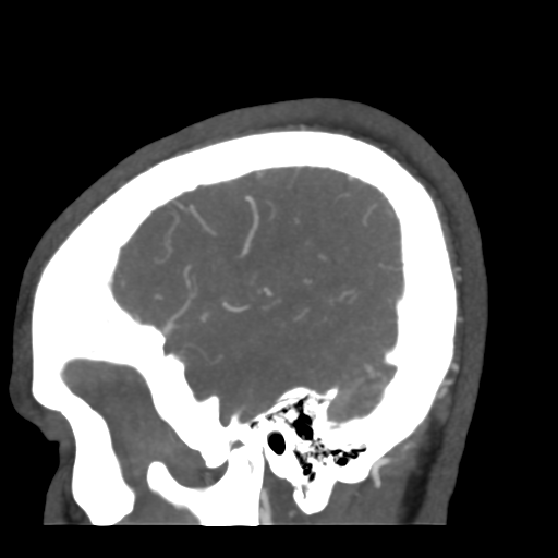 Cerebral arteriovenous malformation (Radiopaedia 39259-41505 Sagittal 11).png