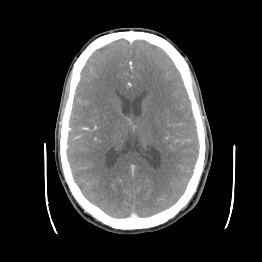 Cerebral arteriovenous malformation (Radiopaedia 55798-62371 B 29).png