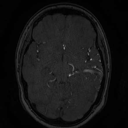 Cerebral arteriovenous malformation (Radiopaedia 74411-85654 Axial MRA 56).jpg