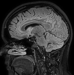 Cerebral arteriovenous malformation (Radiopaedia 74411-85654 Sagittal FLAIR 54).jpg
