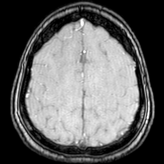 Cerebral arteriovenous malformation at posterior body of corpus callosum (Radiopaedia 74111-84925 Axial MRA 182).jpg