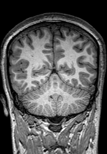 Cerebral arteriovenous malformation at posterior body of corpus callosum (Radiopaedia 74111-84925 Coronal T1 252).jpg