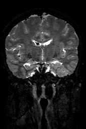 Cerebral arteriovenous malformation at posterior body of corpus callosum (Radiopaedia 74111-84925 Coronal T2 85).jpg