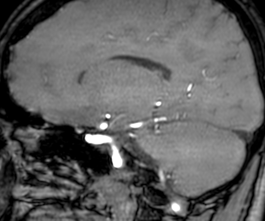 Cerebral arteriovenous malformation at posterior body of corpus callosum (Radiopaedia 74111-84925 J 238).jpg