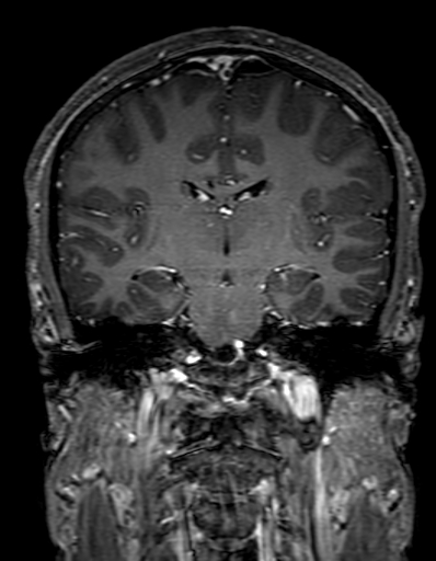 Cerebral arteriovenous malformation at posterior body of corpus callosum (Radiopaedia 74111-84925 K 195).jpg