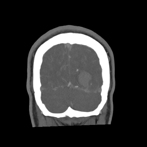 Cerebral arteriovenous malformation with lobar hemorrhage (Radiopaedia 35598-57216 C 80).jpg