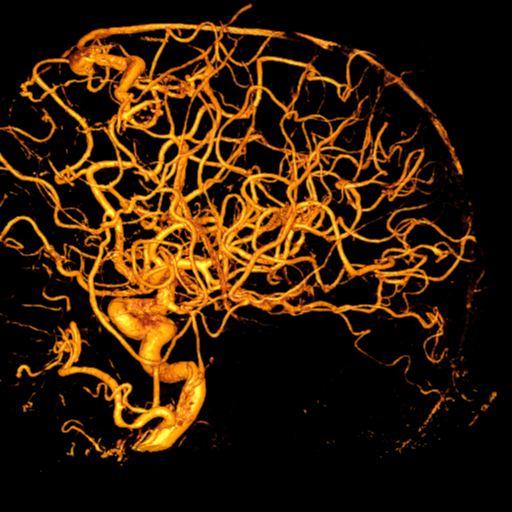 Cerebral arteriovenous malformation with lobar hemorrhage (Radiopaedia 44725-48513 Lateral 57).png