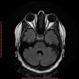 File:Cerebral cavernous malformation (Radiopaedia 26177-26306 FLAIR 7).jpg