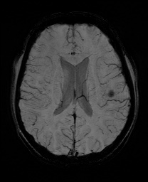 Cerebral cavernous venous malformation (Radiopaedia 70008-80021 Axial SWI 42).jpg