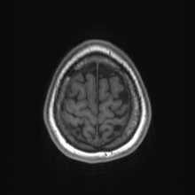 Cerebral cavernous venous malformation (Radiopaedia 70008-80021 Axial T1 86).jpg