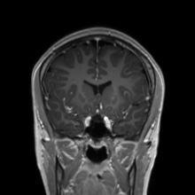Cerebral cavernous venous malformation (Radiopaedia 70008-80021 Coronal T1 C+ 40).jpg