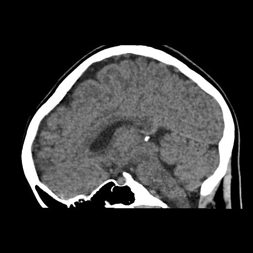 Cerebral cavernous venous malformation (Radiopaedia 70008-80022 C 30).jpg