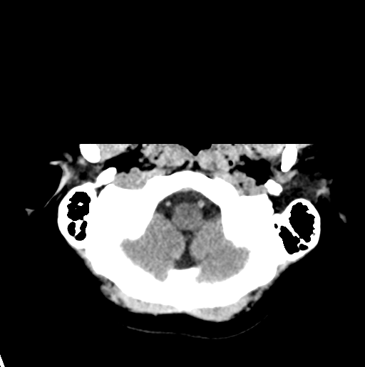 File:Cerebral cavernous venous malformations (Radiopaedia 48117-52945 Axial non-contrast 5).png