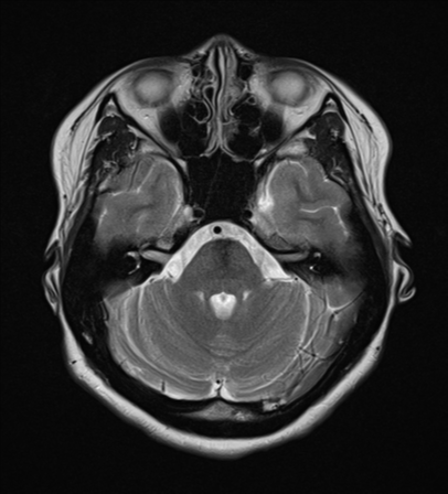 File:Cerebral cavernous venous malformations (Radiopaedia 48117-52946 Axial T2 7).png