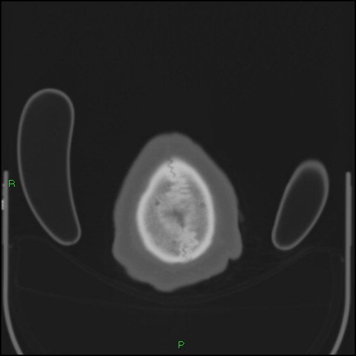 File:Cerebral contusions (Radiopaedia 33868-35039 Axial bone window 219).jpg