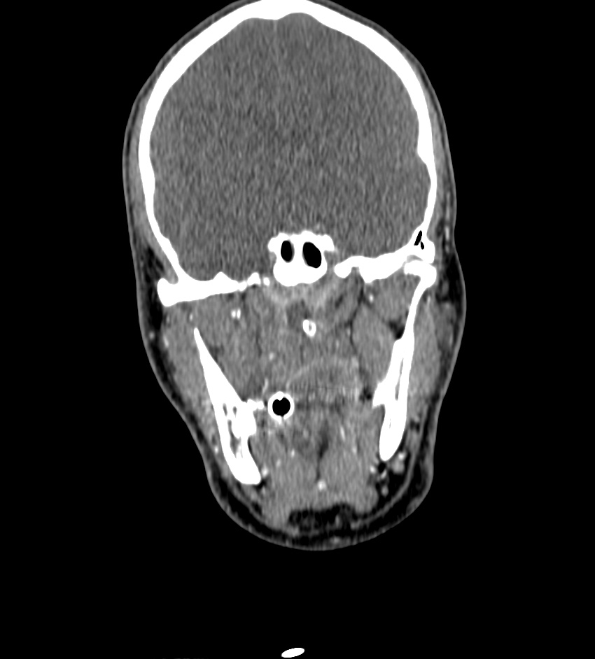Cerebral edema in an overdose patient (Radiopaedia 72005-82539 B 27).jpg