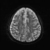 Cerebral embolic infarcts (embolic shower) (Radiopaedia 72391-82921 Axial DWI 22).jpg