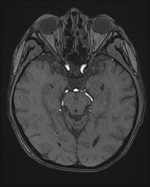 Cerebral embolic infarcts (embolic shower) (Radiopaedia 72391-82921 Axial MRA 59).jpg
