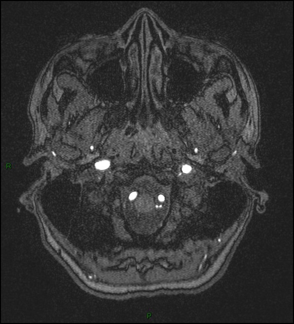 Cerebral fat embolism (Radiopaedia 35022-36525 Axial TOF 11).jpg