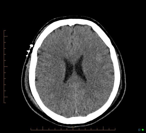 Cerebral fat embolism (Radiopaedia 85521-101224 Axial non-contrast 33).jpg