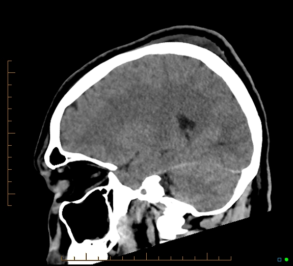 Cerebral fat embolism (Radiopaedia 85521-101224 C 19).jpg
