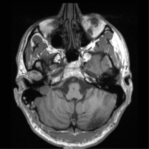 Cerebral hemorrhagic contusions- temporal evolution (Radiopaedia 40224-42757 Axial T1 16).png