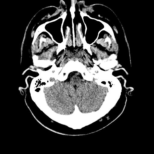 File:Cerebral hemorrhagic contusions and cervical spine fractures (Radiopaedia 32865-33841 Axial non-contrast 6).jpg