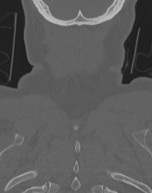 Cerebral hemorrhagic contusions and cervical spine fractures (Radiopaedia 32865-33841 Coronal bone window 73).jpg
