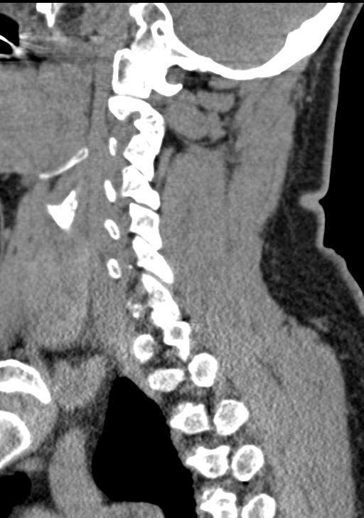 Cerebral hemorrhagic contusions and cervical spine fractures (Radiopaedia 32865-33841 G 72).jpg