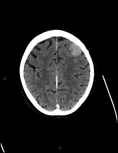Cerebral metastases - ependymal and parenchymal (Radiopaedia 79877-93131 Axial C+ delayed 61).jpg