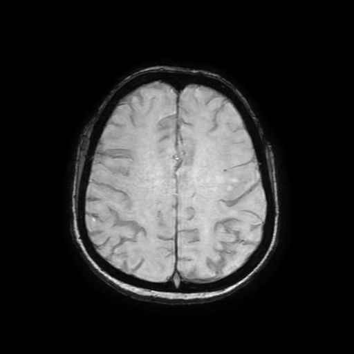 Cerebral metastases - melanoma (Radiopaedia 80972-94522 Axial SWI 70).jpg