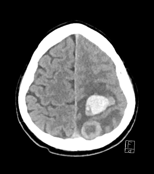 Cerebral metastases - testicular choriocarcinoma (Radiopaedia 84486-99855 Axial non-contrast 15).jpg