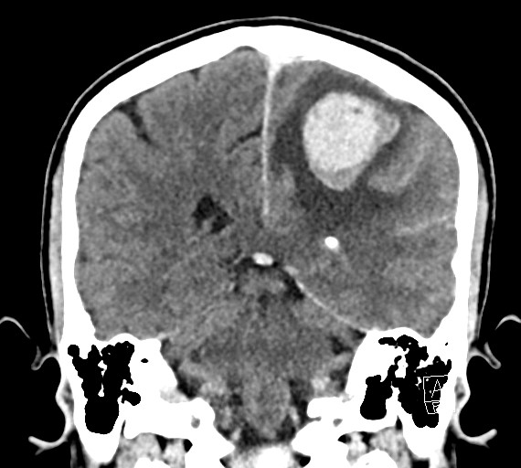 Cerebral metastases - testicular choriocarcinoma (Radiopaedia 84486-99855 D 40).jpg