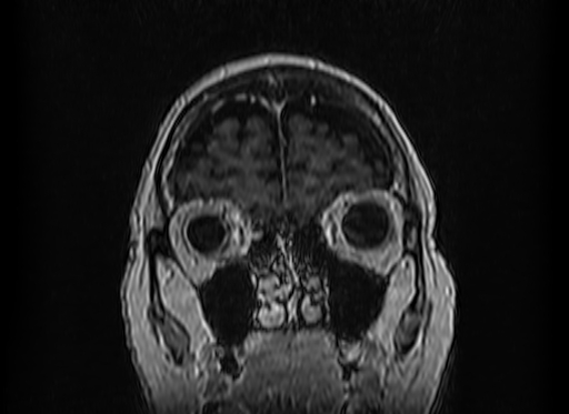 Cerebral metastases from lung cancer with amyloid angiopathy and cerebellopontine angle meningioma (Radiopaedia 74306-85191 Coronal T1 C+ 7).jpg