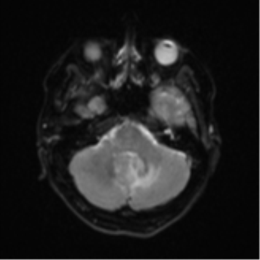 Cerebral metastases mimicking abscesses (Radiopaedia 45841-50131 Axial DWI 8).png