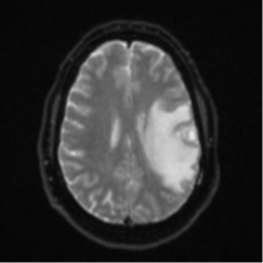 Cerebral metastases mimicking multifocal glioblastoma (Radiopaedia 50843-56353 Axial DWI 18).png
