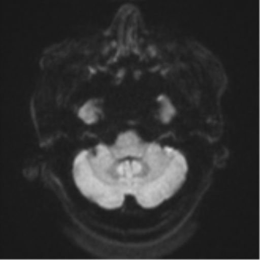 Cerebral metastases mimicking multifocal glioblastoma (Radiopaedia 50843-56353 Axial DWI 34).png
