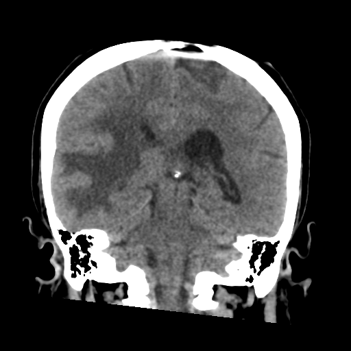 Cerebral metastasis to basal ganglia (Radiopaedia 81568-95412 Coronal non-contrast 43).png