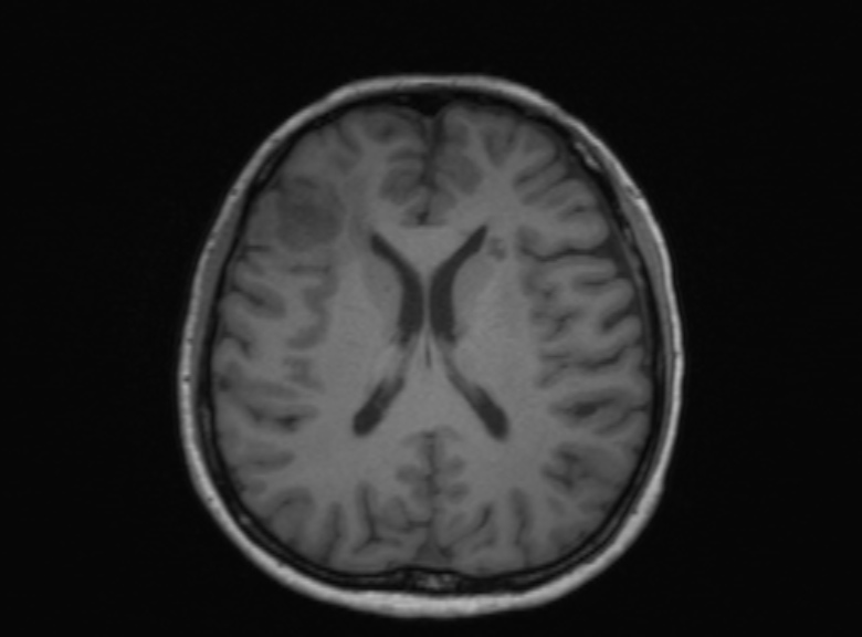 Cerebral ring enhancing lesions - cerebral metastases (Radiopaedia 44922-48817 Axial T1 203).jpg