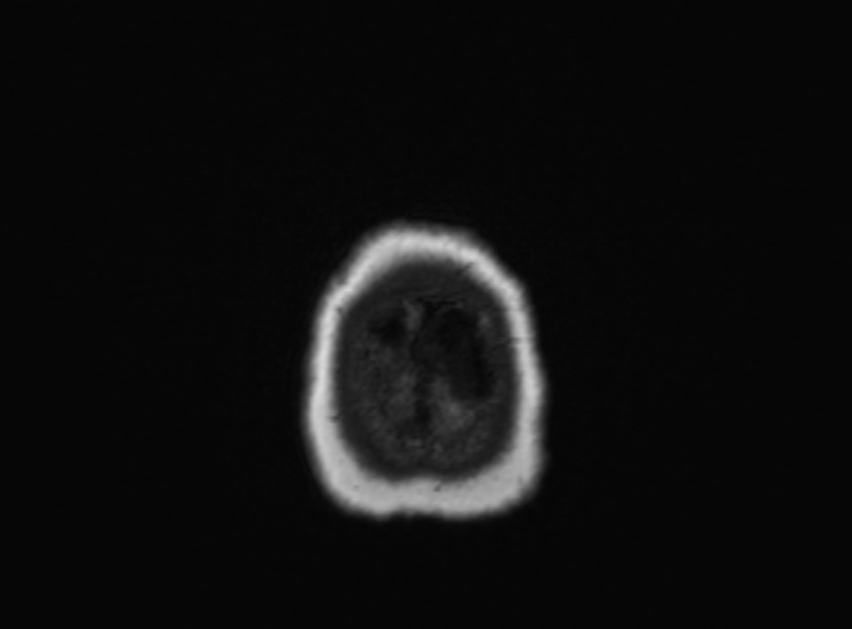 Cerebral ring enhancing lesions - cerebral metastases (Radiopaedia 44922-48817 Axial T1 89).jpg